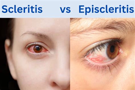 Finding Relief: A Guide to Episcleritis Treatment Options From Your Optometrist